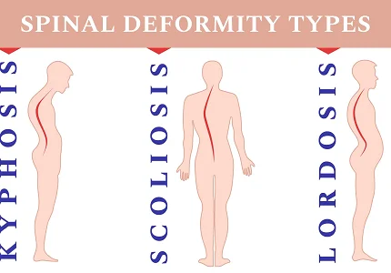 Problemi sa kičmom ne štede ni najmlađe – kako spriječiti trajne deformitete?